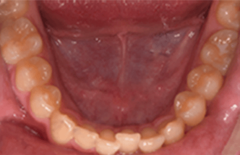 orthodontic retention case study