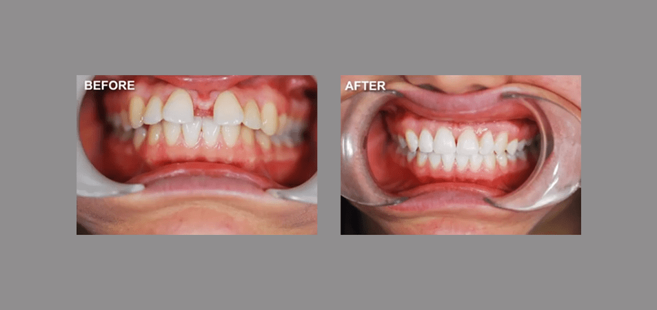 Accelerated Orthodontics Case Study