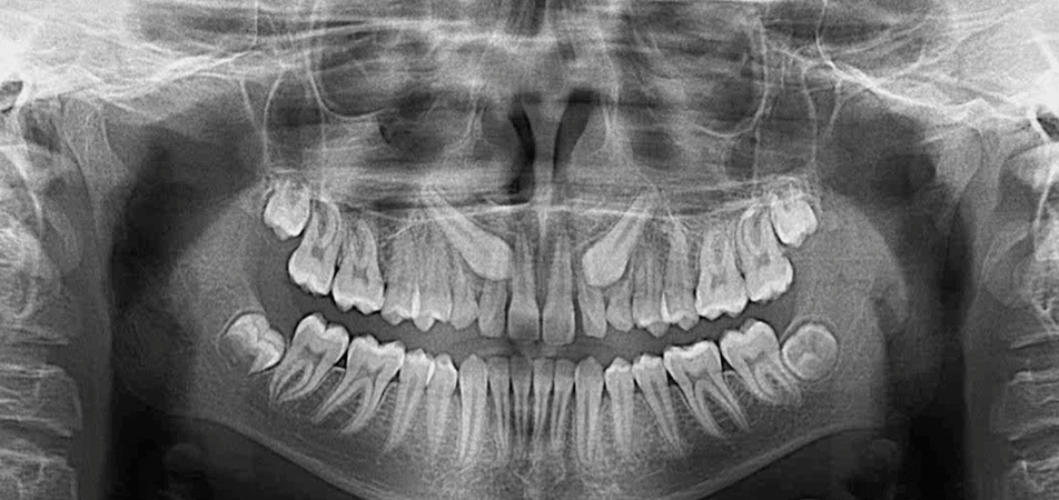 MOPs Impacted Canines Case Study